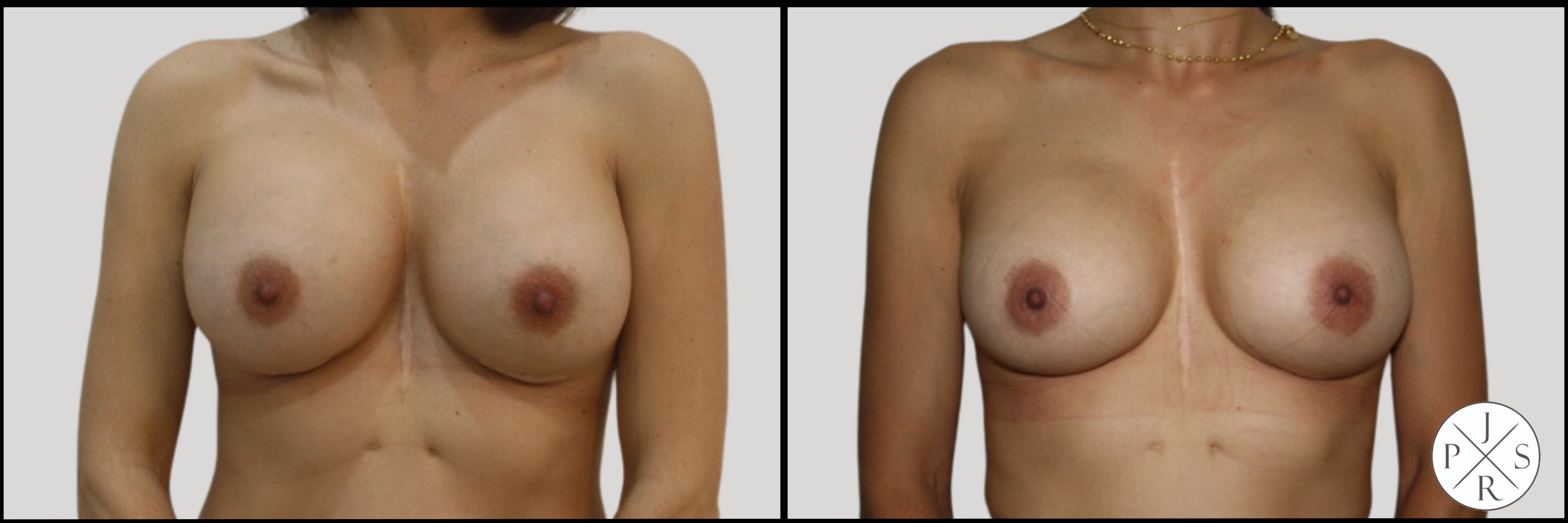 Breast Revision Before & After Image